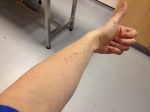 blood splatter arm